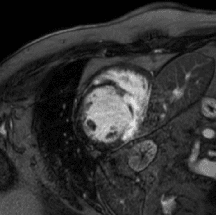 ScarSegNet Cardiac MRI Segmentation